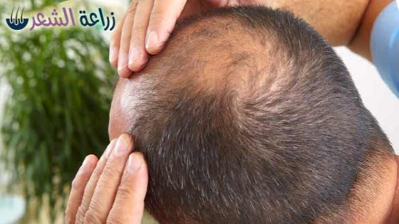 علاج تساقط الشعر للرجال بالأعشاب