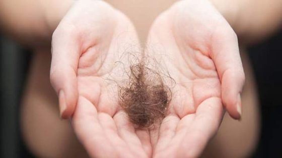 أسباب تساقط الشعر عند النساء وطرق العلاج