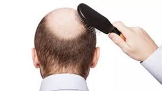 تساقط الشعر عند الرجال .. الأسباب والعلاج