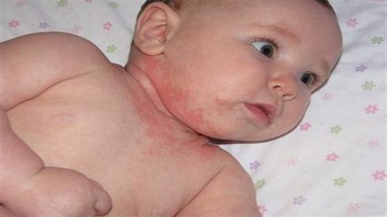 ما أسباب الطفح الجلدي عند الأطفال ؟