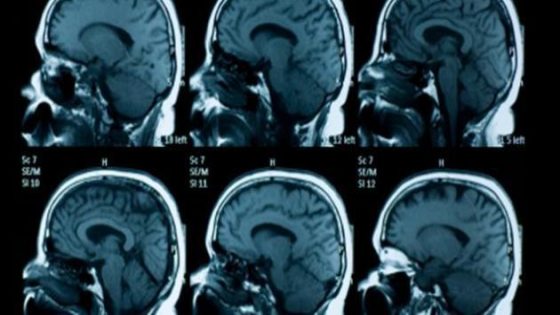 ما هي أعراض ضمور الدماغ ؟