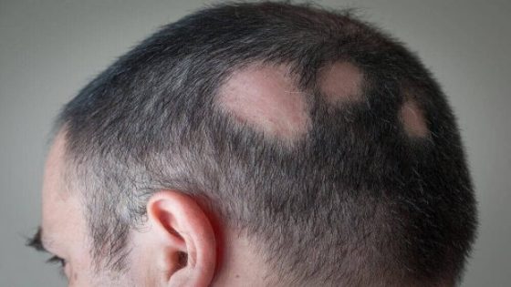 علاج ثعلبة الشعر بشكل طبيعي