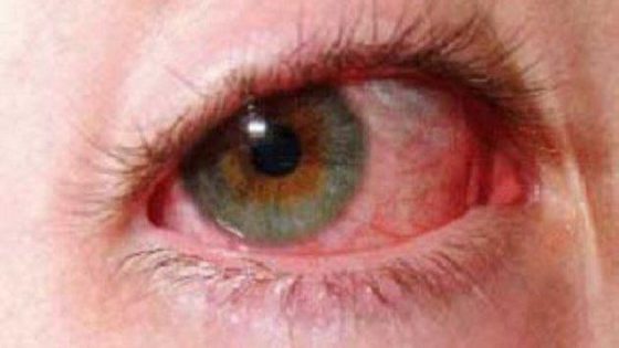 ما هو علاج ضغط العين ؟