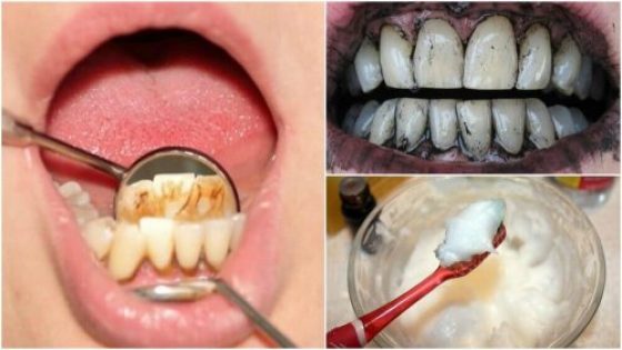 التخلص من جير الأسنان