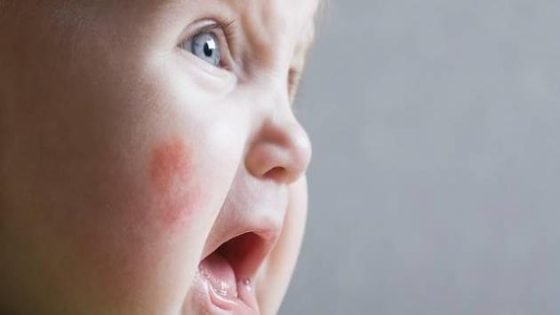 أسباب حساسية الجلد عند الأطفال