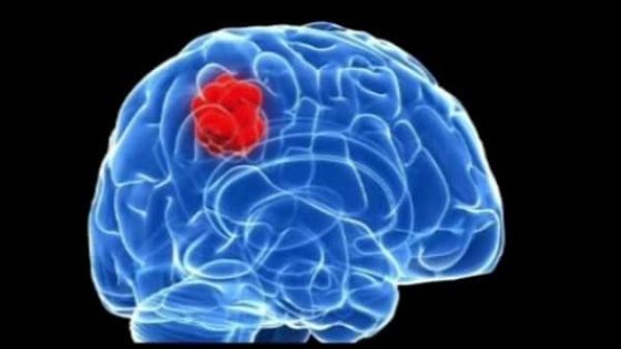 ما هي أعراض ورم الدماغ ؟